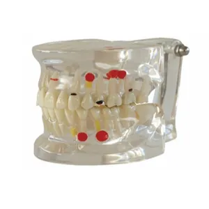 牙科病理模型半侧可拆卸模型