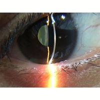 SY-S150D Other Optics Instruments Handheld Slit Lamp with Smartphone APP 6X Magnificatioin Portable Slit Lamp