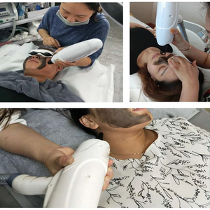 RenwalSkin Hot Carbon Peel Gel Creme para Nd Yag <span class=keywords><strong>Laser</strong></span> Machine - Product Image 3