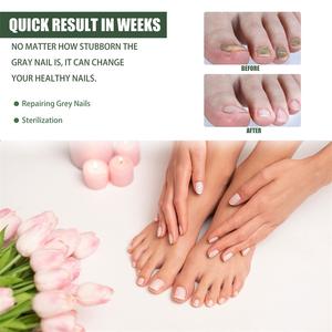 Solution pour l'élimination des champignons des ongles de pied South Moon, essence pour le traitement des champignons des ongles, stylo laser diode, kit - Product Image 3