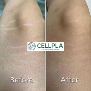 Cellpla 细胞血浆机 去除妊娠纹 去除脂肪团 去除疤痕 - Product Image 4