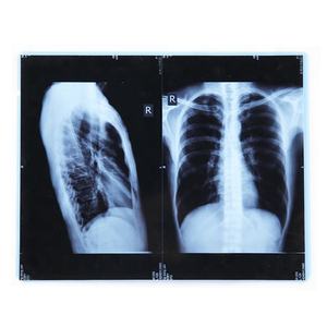 Película Médica de Impresión por Inyección de Tinta, Base Azul, Radiología Seca, Impresión de Rayos X, DR, CR, <span class=keywords><strong>CT</strong></span> - Product Image 5