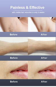 Dispositif permanent indolore d'épilation de chargement initial de refroidissement par glace de corps entier portatif pour des femmes hommes - Product Image 5