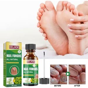 Kit EELHOE per Micosi delle <span class=keywords><strong>Unghie</strong></span> <span class=keywords><strong>dei</strong></span> <span class=keywords><strong>Piedi</strong></span> con Spazzola, Essenza Riparatrice per <span class=keywords><strong>Unghie</strong></span>, Trattamento Naturale per Micosi delle <span class=keywords><strong>Unghie</strong></span> <span class=keywords><strong>dei</strong></span> <span class=keywords><strong>Piedi</strong></span> 10ml/flacone - Product Image 3