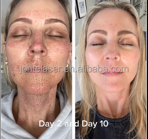 Tıbbi CE 10600nm kırışıklık giderici vajinal sıkma fraksiyonel Co2 lazer güzellik makinesi - Product Image 4