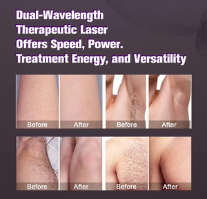 Fibra de alta calidad Alexander 755 1064nm Alex Alexandrite Laser Long Pulse Yag Laser Hair Removal Machine Precio - Product Image 5