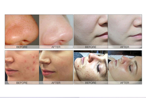 Máquina de Hidrodermoabrasión de Material ABS, Microdermoabrasión con Jet Peel para Salón de Belleza, Aprobada por la CE, 2 Años de Garantía - Product Image 5