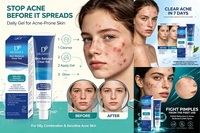 Crème-gel anti-acné en gros : cible les boutons, les rougeurs et les marques post-acnéiques