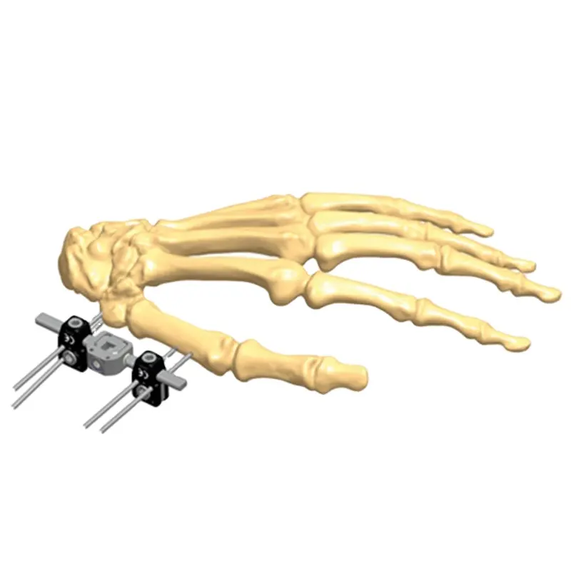 제 1 metacarpal 외부 fixator의 근위 관절 내 골절을위한 미니 fixator