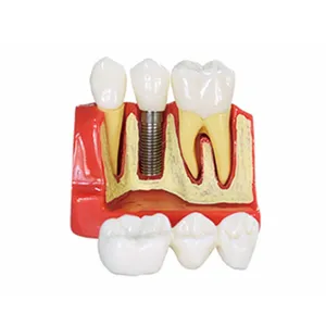Implant dentaire 4 fois et modèle de dents de démonstration de pont en porcelaine