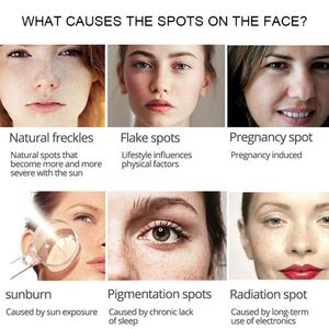 Crema y Loción Facial con Logotipo Personalizado OEM, Cuidado de la Piel con Melanina, Aclarante y Eliminador de Pecas para una Piel Más Brillante - Product Image 2