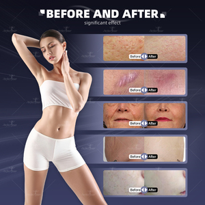 Da mỹ phẩm CO2 laser chuyên nghiệp loại bỏ vết sẹo máy âm đạo thắt chặt trẻ hóa da fractional Laser CO2 - Product Image 5