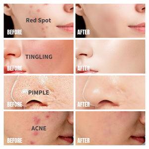 कस्टम लोगो निजी लेबल वेगन एंटी एलर्जी और एंटी-मुँहासे लालिमा को हटाने वाली सुखदायक मरम्मत स्पॉट क्रीम - Product Image 5