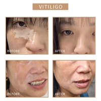 Couvre-vitiligo naturel pour une couverture parfaite et un mélange parfait avec le teint de la peau environnante, traitement PMU