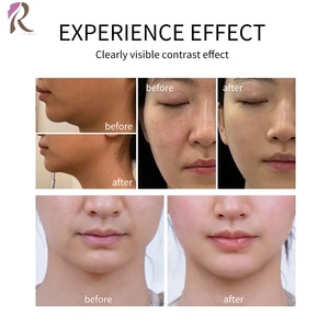 Dispositivo de Belleza Profesional <span class=keywords><strong>Wontech</strong></span> Oligio 6.78MHz Monopolar RF Antienvejecimiento, Lifting Facial y Reafirmación de la Piel - Product Image 2