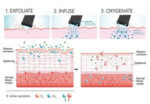 Glowskin O + Release Zuurstof Spa Huid Bohr Effect Co2 Bubble Zuurstof Gezichtsschoonheidsmachine - Product Image 4