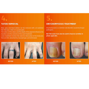 Mesin <span class=keywords><strong>Laser</strong></span> penghilang bulu, mesin <span class=keywords><strong>Laser</strong></span> penghilang bulu nd yag 1064nm - Product Image 6