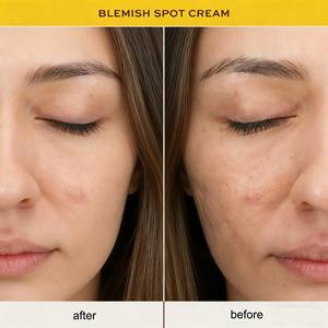 OEM Crème d'élimination rapide et efficace des boutons Crème à base de plantes pour les taches d'acné Crème pour les boutons d'acné Crème anti-acné <span class=keywords><strong>visage</strong></span> à l'acide salicylique - Product Image 5