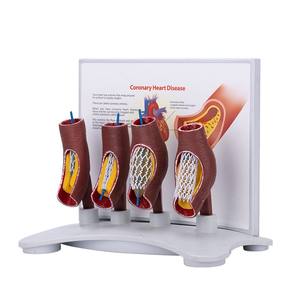 कोरोनरी हृदय रोग के लिए शैक्षिक उपकरण 4-चरण स्टेंट तैनाती प्रदर्शन मॉडल - Product Image 3