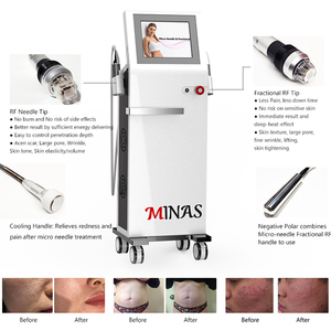 Macchina per Microaghi a Radiofrequenza Profonda <span class=keywords><strong>Vivace</strong></span> Scarlet per Salone di Bellezza, Modello TM50B - Product Image 4