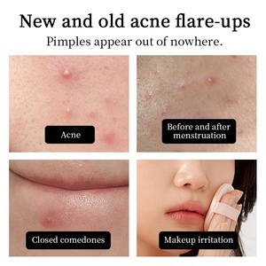 Parches para espinillas faciales, 40 unidades, de hidrocoloide en forma de estrella, para tratamiento del acné, cubre granos bonitos, pegatinas coloridas para manchas, cuidado de la piel sin crueldad animal - Product Image 4