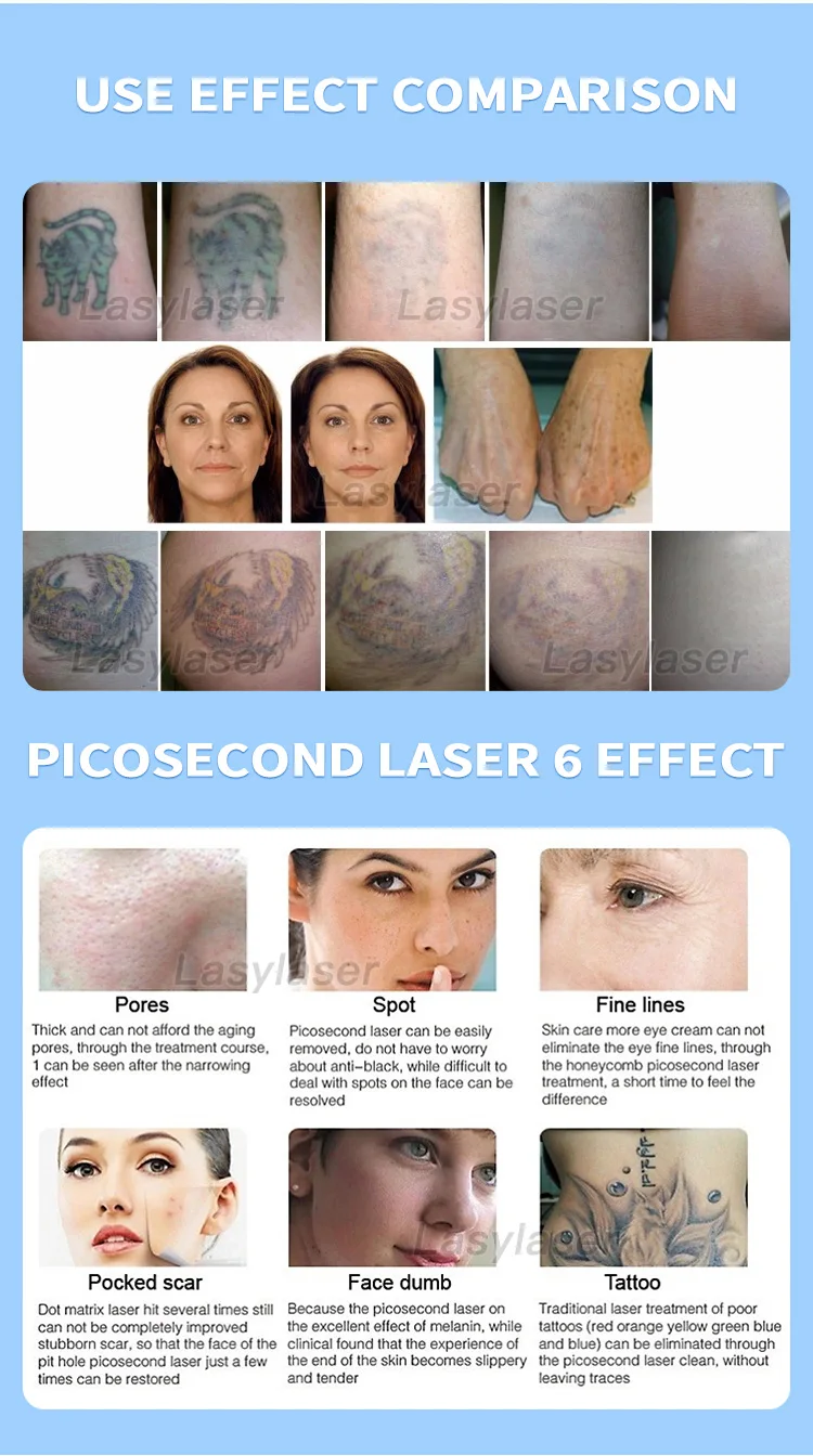 ND :Équipement d'instrument de laser de picoseconde de YAG pour enlever des rides et des cicatrices pour éclairer des pores et pour améliorer l'acné