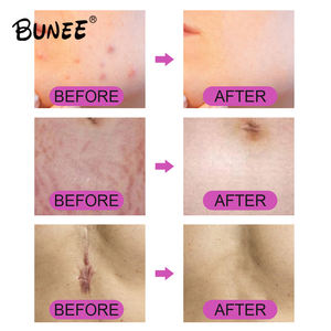 Nouveaux produits de beauté acné <span class=keywords><strong>cicatrice</strong></span> soins de la peau cheveux barbe croissance rouleau 1.0 pour acné <span class=keywords><strong>cicatrice</strong></span> soins de la peau Massage du cuir chevelu - Product Image 3