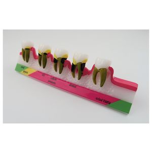 Modelo de desarrollo de enfermedades periodontales, modelo de dientes de demostración de educación dental - Product Image 5