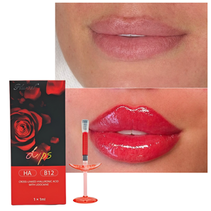 Premium Mono-Phase Cross-Linked HA Dermal Filler Enriched with VB12 for <strong>Lip</strong> <strong>Augmentation</strong> - Product Image 2