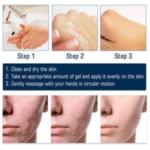 Gel de Alta Calidad West Month para Reducir la Rojez, Eliminar Cicatrices de Cesárea, Abdominoplastia, Quemaduras, Estrías y Queloides - Product Image 4