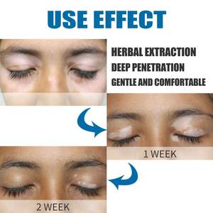 Crema de Extracto Herbal para <span class=keywords><strong>Tratamiento</strong></span> de Vitiligo, Leucoplasia y <span class=keywords><strong>Tiña</strong></span>, Pomada para Eliminar Manchas Blancas, Suministro de Salud - Product Image 6