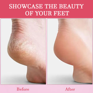 <span class=keywords><strong>Crema</strong></span> de <span class=keywords><strong>Urea</strong></span> Personalizada para Bebés y Adultos, Hidratante para Pies, Tratamiento para Manchas Oscuras, Exfoliante para Piel Muerta, Previene Grietas - Product Image 4