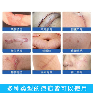 Cinta de Gel de Silicona para Cicatrices, 0.7mm de Grosor, Adhesivo Impermeable para Reparación y Protección de Cicatrices de Cesárea e Hipertróficas - Product Image 4