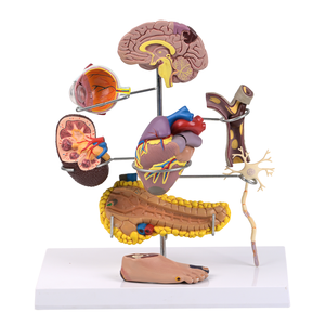 Modelo Anatómico Médico <span class=keywords><strong>de</strong></span> Diabetes <span class=keywords><strong>de</strong></span> 8 Partes, Desmontable, <span class=keywords><strong>de</strong></span> PVC, con Globo Ocular, Corazón, Riñón, Vasos Sanguíneos y Pie, con Patología - Product Image 1