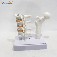 Modelo Anatómico de Patología de Densidad Ósea, Ayuda de Demostración Científica Popular sobre Osteoporosis, CE/ISO/ROHS/CNAS