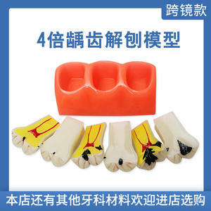 Modelo Anatómico de Caries Dental de Resina, Modelo de Dientes para el Cuidado Bucal, para Educación en Ciencias Médicas - Product Image 5