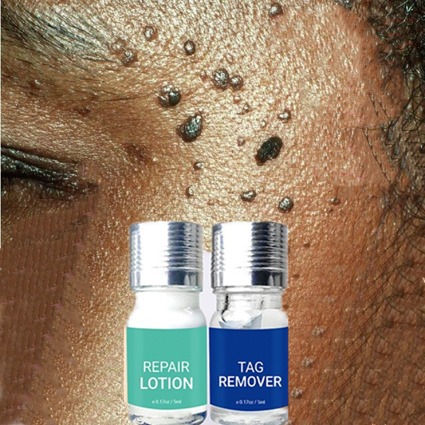 Warts Remover Ointment Wart Treatment Cream Skin Tag Remover Solution Painless Mole Skin Dark Spot moles skin tags