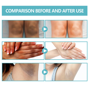 Crema Terapéutica para Acanthosis Nigricans de Marca Privada, 50g, para Espalda, Codos, Rodillas, Nudillos, Hidratante, Iluminadora y Exfoliante - Product Image 4