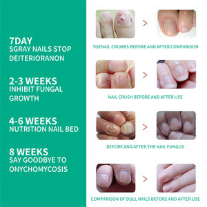 OUHOE - Líquido Reparador de <span class=keywords><strong>Hongos</strong></span> <span class=keywords><strong>en</strong></span> <span class=keywords><strong>las</strong></span> <span class=keywords><strong>Uñas</strong></span> de 30 ml, Infecciones por <span class=keywords><strong>Hongos</strong></span>, Decoloración de <span class=keywords><strong>las</strong></span> <span class=keywords><strong>Uñas</strong></span>, Reparación de <span class=keywords><strong>Uñas</strong></span> Agrietadas, Solución Abrillantadora - Product Image 3