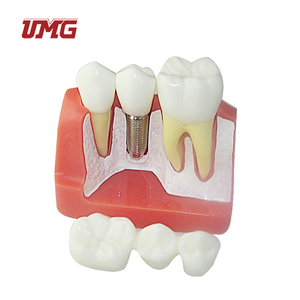 Zahnärztliches Demonstrations-Zahnmodell für Implantatanalyse Kronen-Brücken-Training Medizinisches Anatomisches Modell <span class=keywords><strong>UMG</strong></span> UM-Z1 - Product Image 3