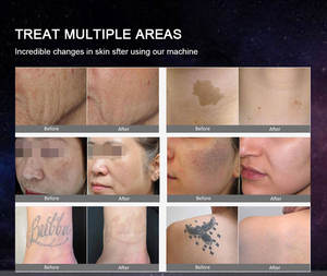 เลเซอร์ลบรอย<span class=keywords><strong>สัก</strong></span><span class=keywords><strong>คิ้ว</strong></span>532nm Q-Switch ขนาด1064 NM เลเซอร์ลอกรอยสักที่ได้รับการรับรองจาก CE สำหรับร้านเสริมสวย - Product Image 5