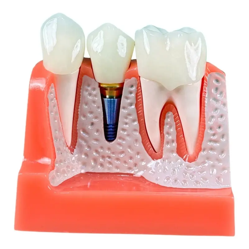 Educazione dentale 4 volte studiare il modello di impianto dentale per l'educazione dente modello di insegnamento anatomico
