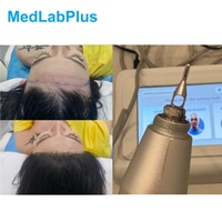 Mesin Transplantasi Rambut FUE, Peralatan Transplantasi Rambut, Punch FUE Rambut Panjang