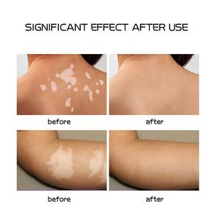 <span class=keywords><strong>Gel</strong></span> douche apaisant pour l'eczéma, nettoyant pour peaux sèches et irritées, traitement du <span class=keywords><strong>psoriasis</strong></span> avec acide salicylique, acide hyaluronique, aloès et romarin - Product Image 4