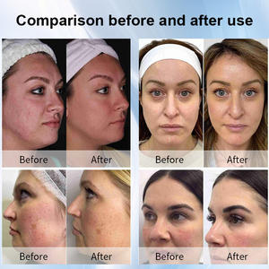 Máquina de Rejuvenecimiento Facial y Corporal, Eliminación de Acné, Cicatrices y Arrugas, Masajeador de Senos, Disponible en EE. UU. - Product Image 6