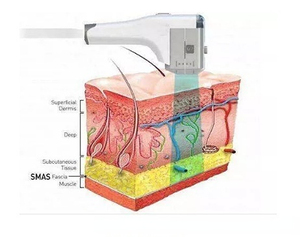 2025 New arrivals xách tay 7D 9D 11D 12D HIFU mô đường viền tăng cường chính xác mô tu sửa - Product Image 6