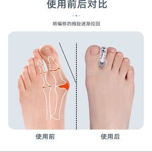 Séparateur d'orteils magnétique, correcteur d'hallux valgus en silicone, réglable, pour adultes, pour le soin des pieds - Product Image 4