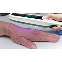 Highly uvb light for psoriasis -