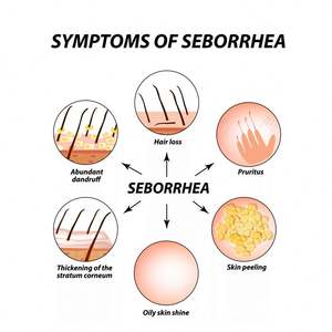 Crème de soin du <span class=keywords><strong>cuir</strong></span> <span class=keywords><strong>chevelu</strong></span> South Moon, crème nettoyante, hydratante et réparatrice pour le <span class=keywords><strong>cuir</strong></span> <span class=keywords><strong>chevelu</strong></span>, soulagement des démangeaisons et de l'eczéma, soin topique - Product Image 6