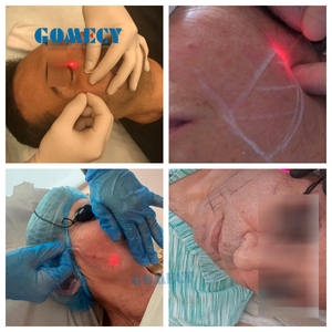 Appareil <span class=keywords><strong>laser</strong></span> diode 1470nm 980nm pour <span class=keywords><strong>lipolyse</strong></span>, élimination des graisses, amincissement, endolaser, endolifting, élimination vasculaire, endolift - <span class=keywords><strong>Prix</strong></span> - Product Image 2